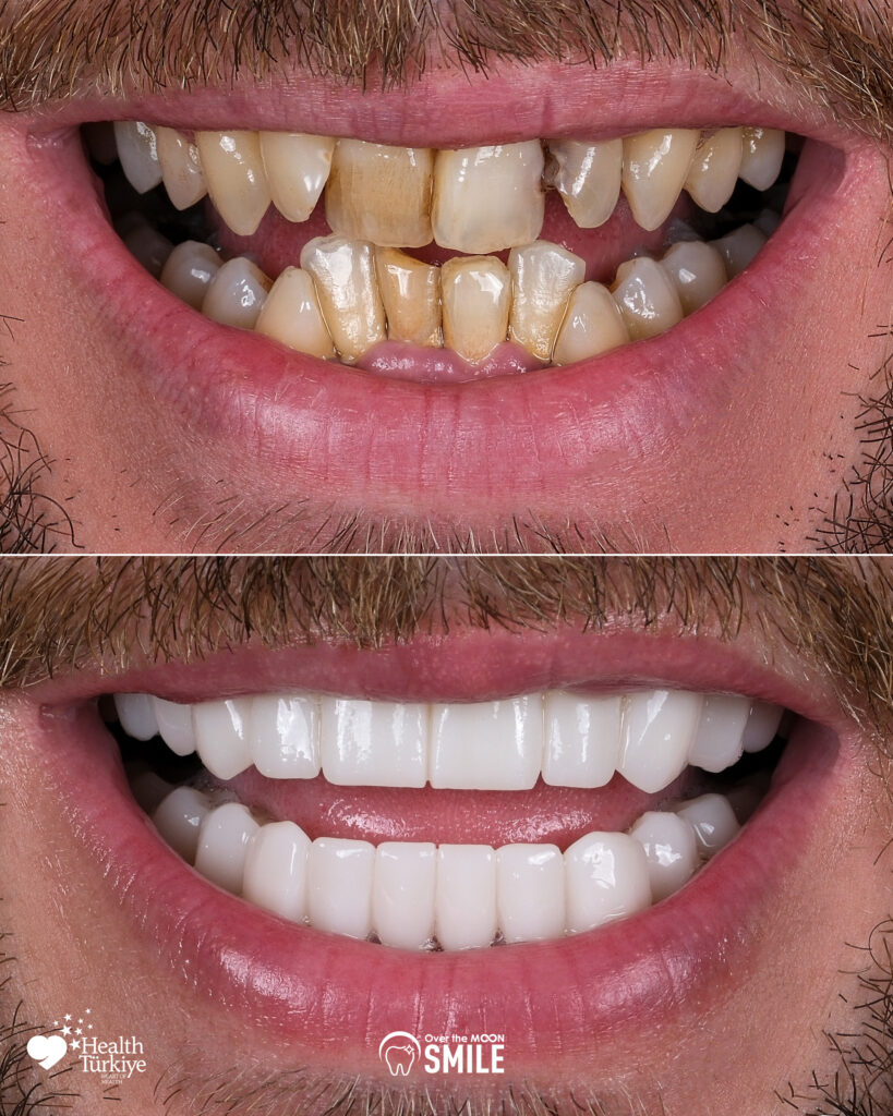 Over The Moon Smile Turkey Teeth Hollywood Smile White Teeth