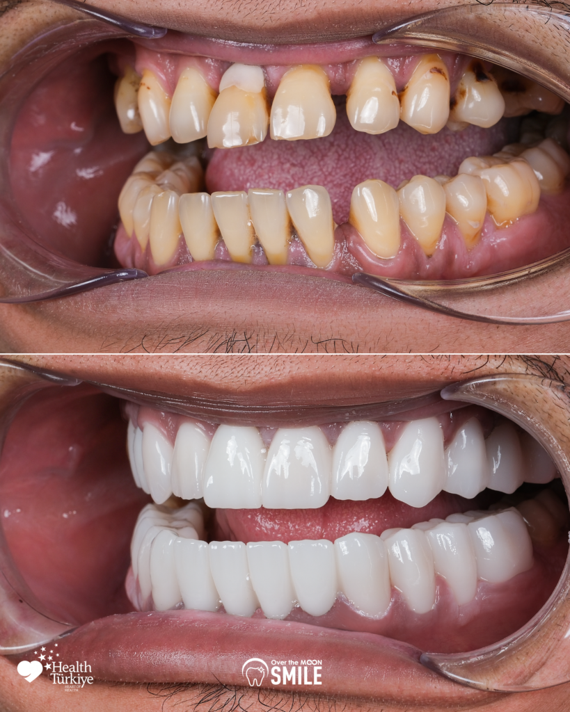 Over The Moon Smile Turkey Teeth Hollywood Smile White Teeth