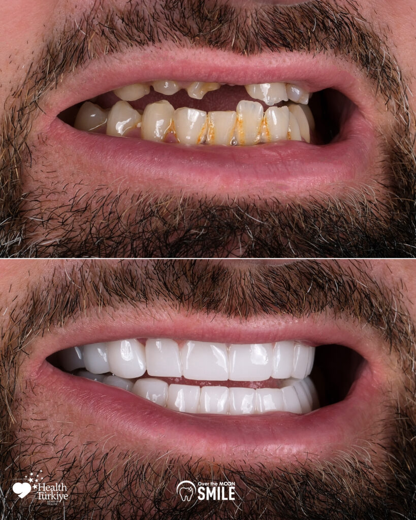 Over The Moon Smile Turkey Teeth Hollywood Smile White Teeth