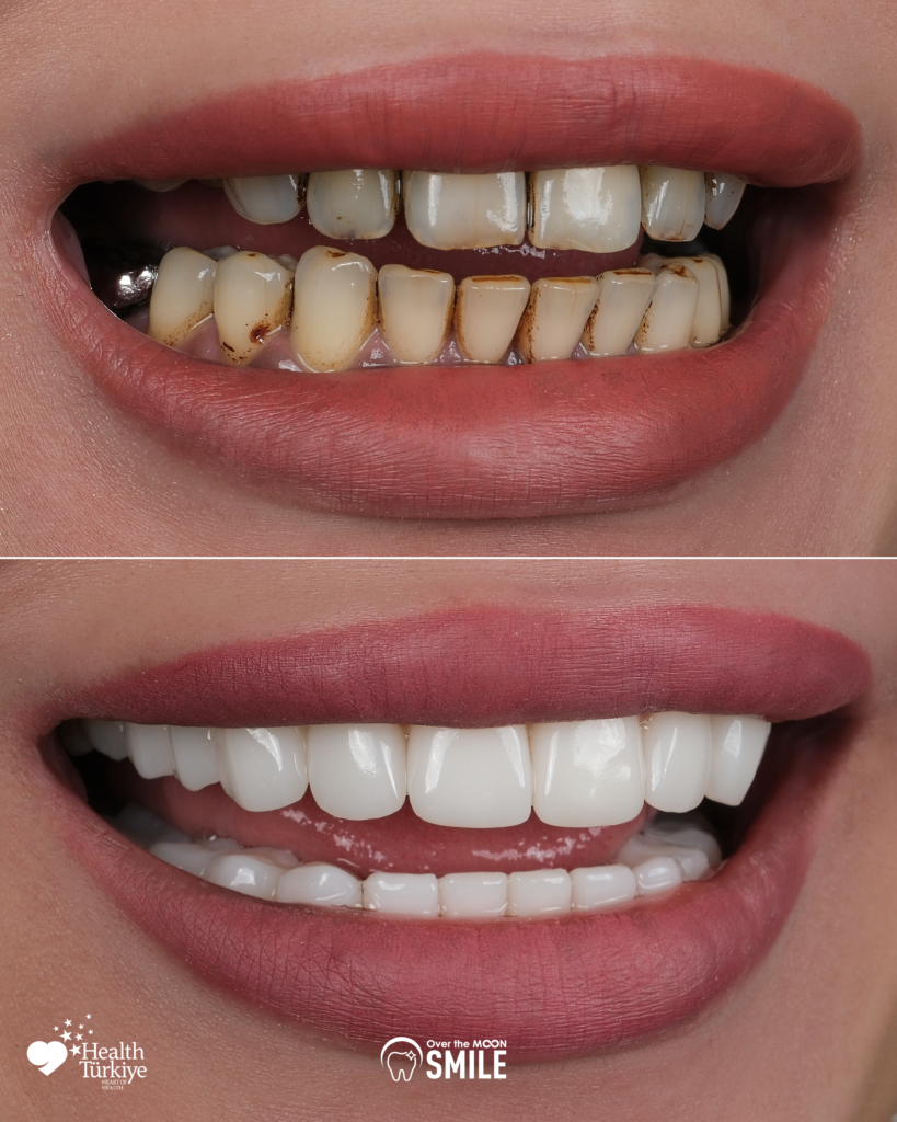 Over The Moon Smile Turkey Teeth Hollywood Smile White Teeth